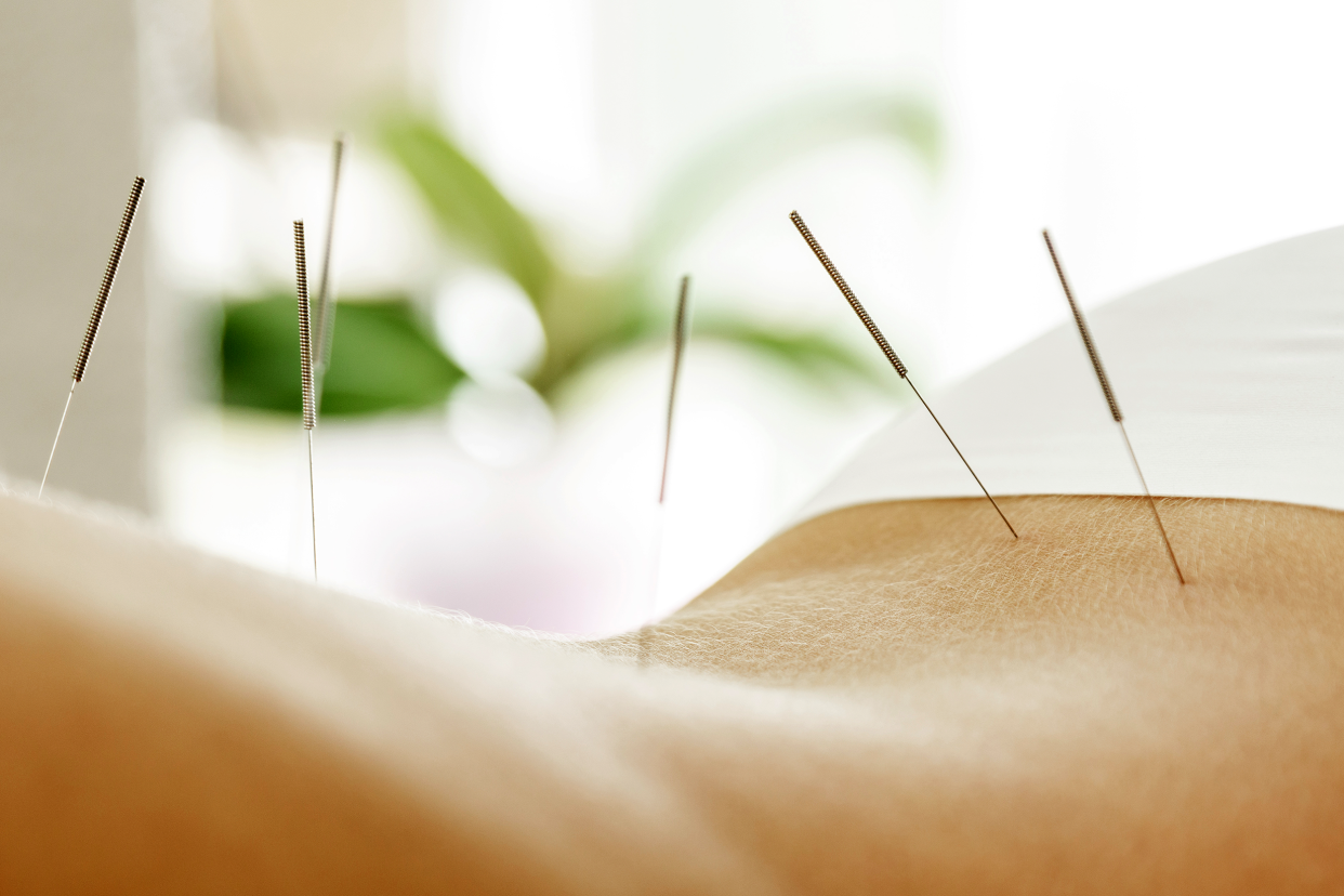 acupuncture needles on a woman's back