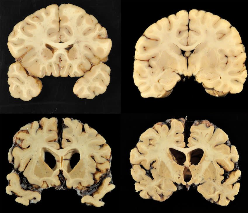 A number of the brains studied by doctor&nbsp;Ann McKee and her researchers.&nbsp;Almost all of the brains&nbsp;McKee has studied were found to have&nbsp;CTE. (Photo: BU Photography)