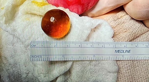 PHOTO: Hannah Rief shared a photo of the water bead removed from her 14-month-old daughter's small intestine. (Courtesy of Hannah Rief)