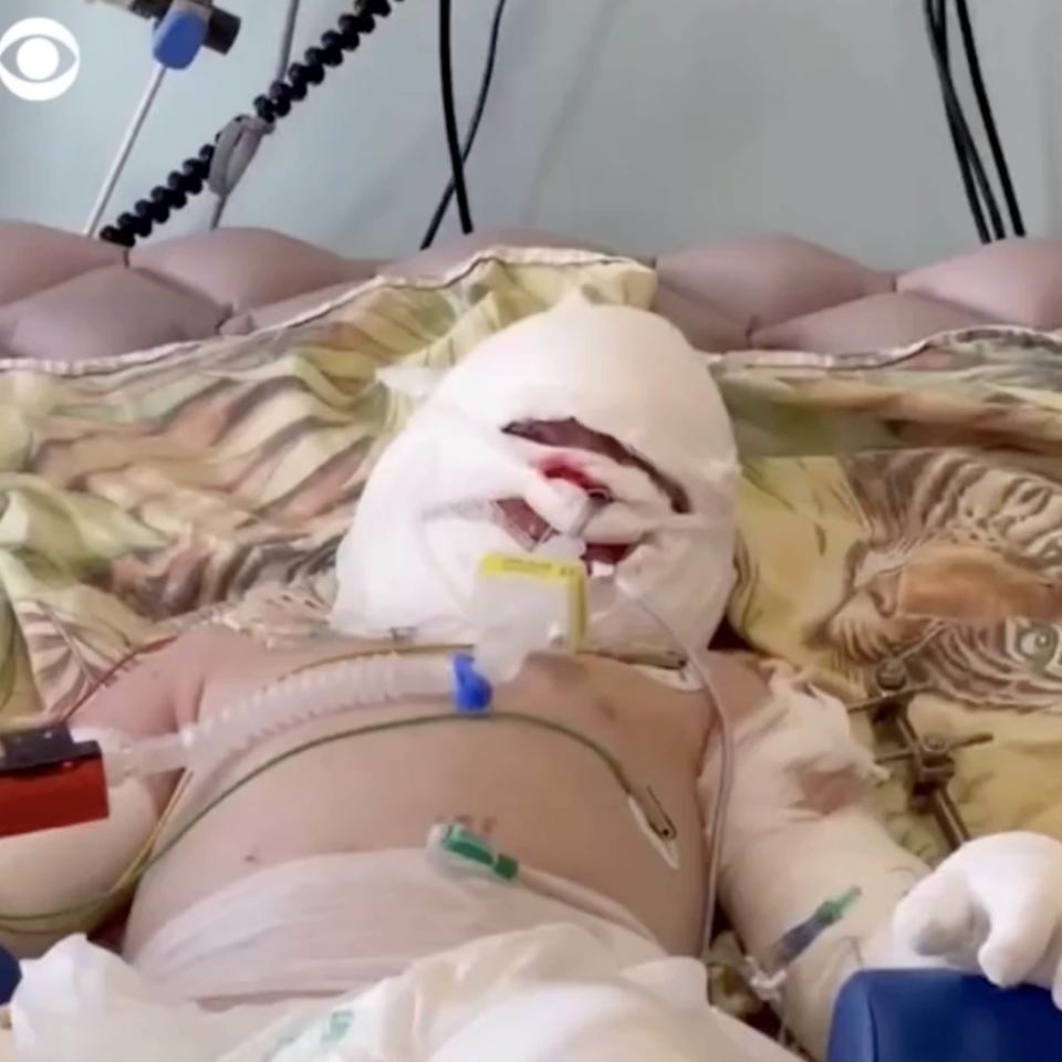 Seven-year-old Roman Oleksiv recovers in hospital after suffering burns on nearly half his body from a Russian missile strike - CBS/CBS