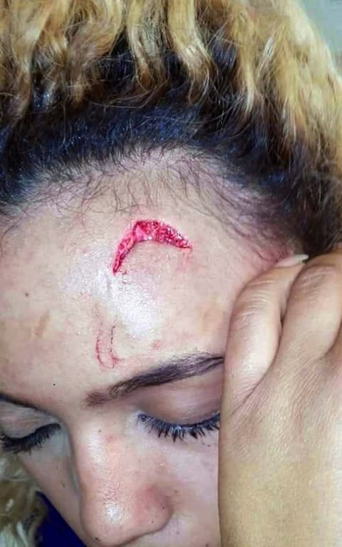 Gabriella Engels is seen with an injury to her forehead  - Credit: Debbie Engels via AP