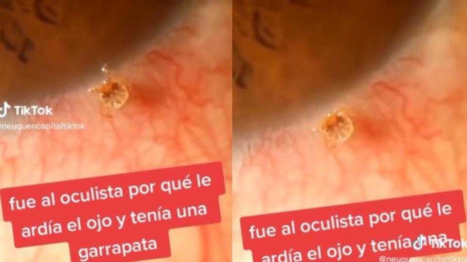阿根廷老翁被發現眼睛上有蜱蟲寄生。（圖／翻攝自@neuquencapitaltiktok　TikTok）