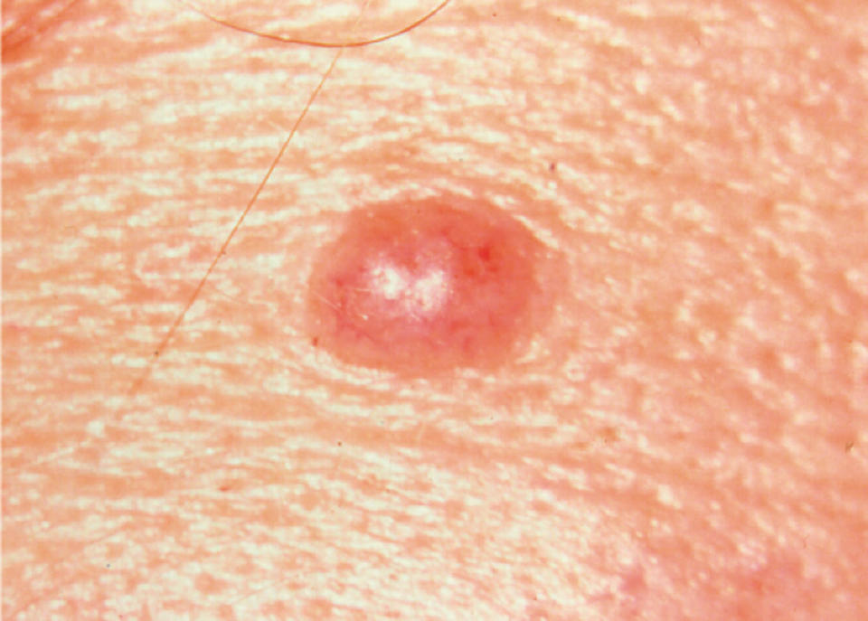 slightly asymmetrical but non-cancerous mole (Courtesy The Skin Cancer Foundation)