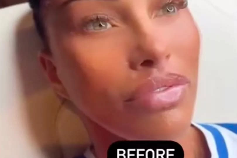 Katie Price lying down having lip filler inserted