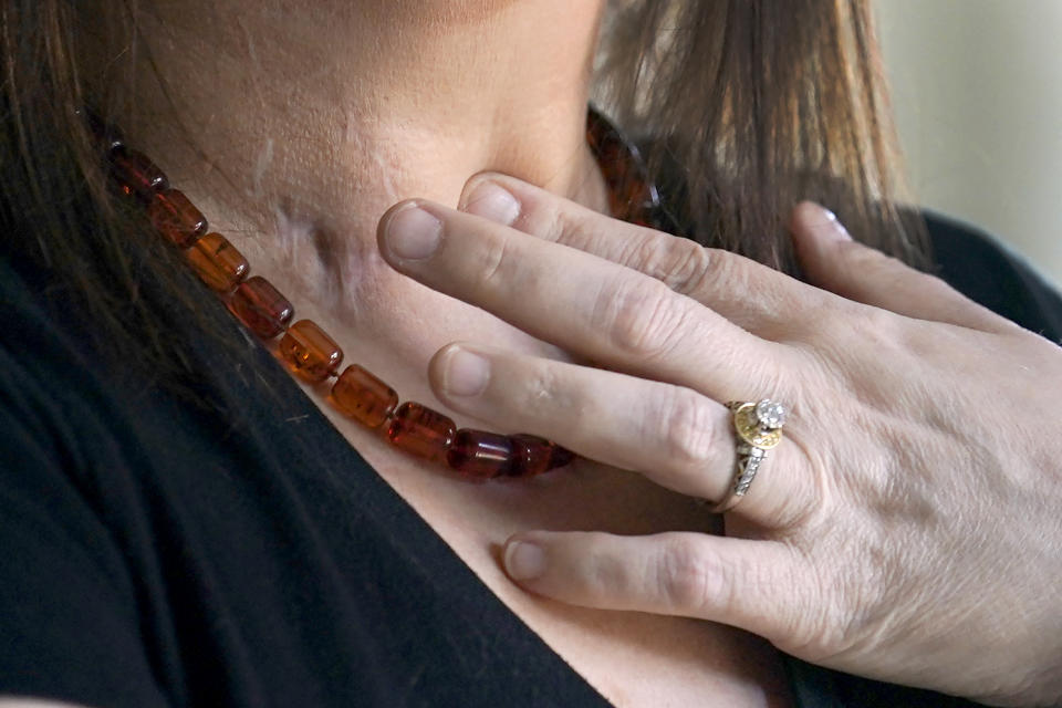 Kari Wegg places her index finger on her tracheotomy scar with her Extracorporeal Membrane Oxygenation machine, ECMO, scar visible next to it during an interview in her home in Westfield, Ind., on Sunday, March 21, 2021. For two weeks after her double lung transplant surgery, Kari struggled to focus on something besides the hurt. “All I could think of was keeping the pain to a minimum and that was really hard,” she says. “They’d cracked open my whole chest like a drawbridge.” (AP Photo/Charles Rex Arbogast)