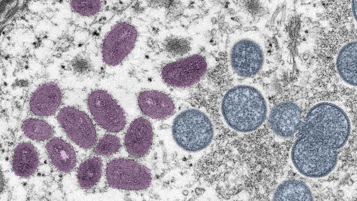 <div>Digitally-colorized electron microscopic (EM) image depicting a monkeypox virion (virus particle), obtained from a clinical sample associated with a 2003 prairie dog outbreak, published June 6, 2022. The image depicts a thin section image from a human skin sample. On the left are mature, oval-shaped virus particles, and on the right are the crescents and spherical particles of immature virions. Courtesy CDC/Goldsmith at al. (Photo via Smith Collection/Gado/Getty Images)</div>