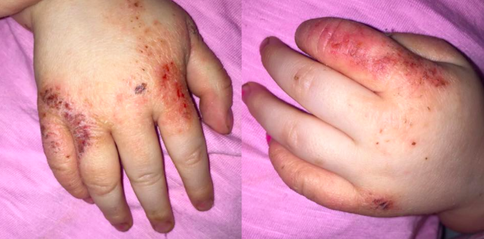 A mum has praised a Childs Farm moisturiser for helping to 'cure' her daughter's eczema [Photo: Facebook/Paige Sweeney]