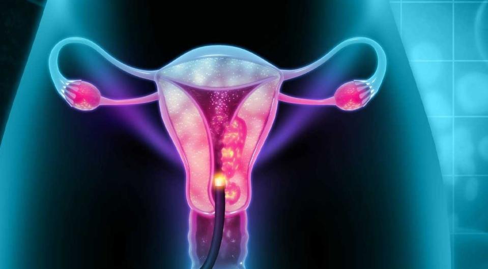El cáncer de cuello uterino se puede evitar mediante vacunación y también tiene tratamiento 