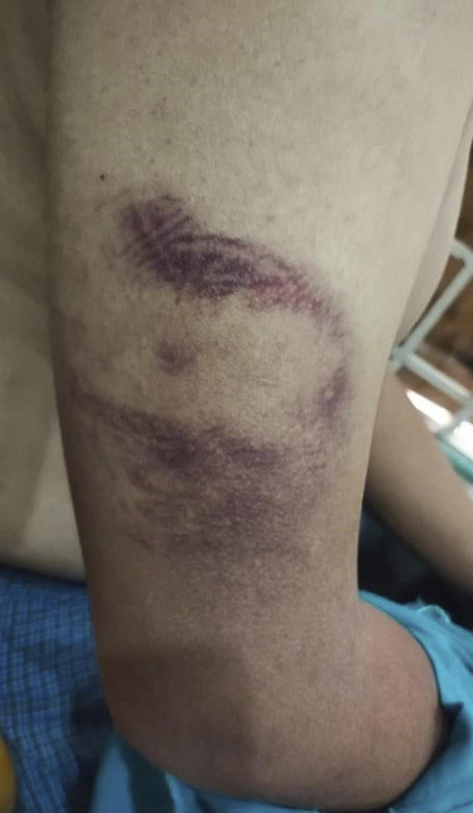 This photo obtained by The Associated Press shows injuries a man in his 20s says he received while being tortured by Myanmar's military during an interrogation session in March 2021. He says he was one of six youths who were arrested while sitting at a restaurant one evening. All of them were allegedly beaten during their arrest and questioning. They were released the next day. (AP Photo)