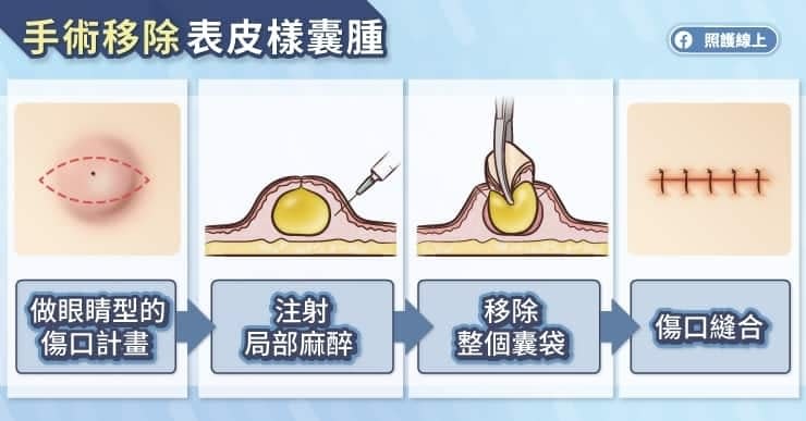 粉瘤需要處理嗎？怎麼處理？