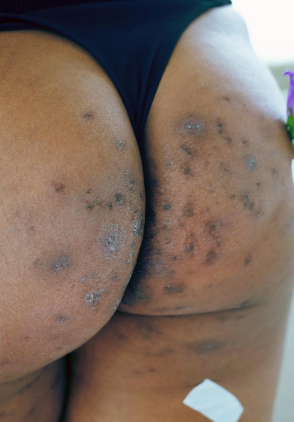 Hidradenitis suppurativa develops in skin fold areas such as under the arms, in the groin, under the breasts and on the butt. (Courtesy HS Connect / Mahala Preudhomme)