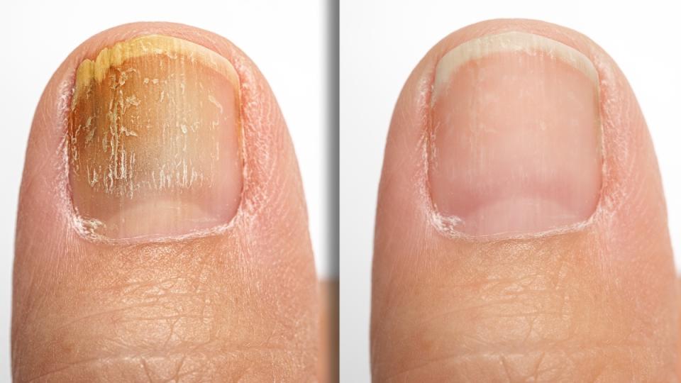A yellow, brittle nail with toenail fungus compared to a healthy nail