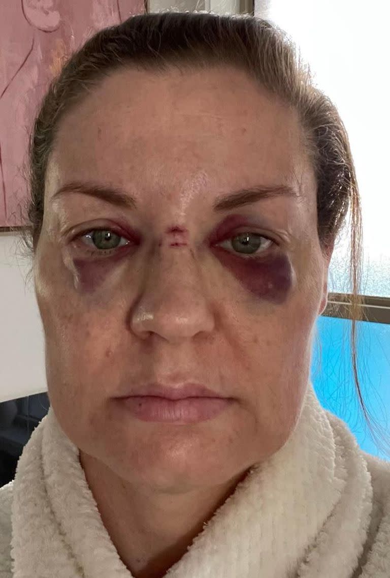 Rebecca Howe, la mujer que asegura que un micrófono arrojado por Axl Rose impactó en su rostro