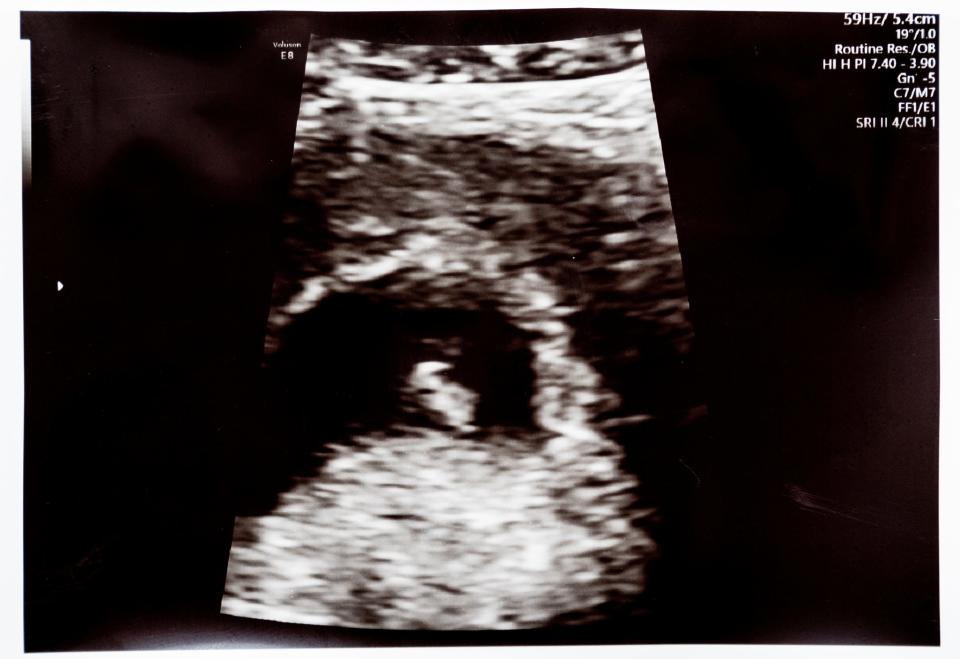 An image of a six week, 3 day old embryo is seen on an ultrasound.