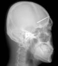 The X-ray picture shows a 5-centimeter nail stuck in an unidentified South Korean patient's skull Thursday, Dec. 2, 2004. According to a Seoul hospital, doctors found the nail after the man came to the hospital, complaining about a severe headache. They speculate that the nail stuck in the man's head four years ago in an accident but the man didn't know about it. The nail was removed in a surgery last Saturday. (AP Photo/Yonhap).