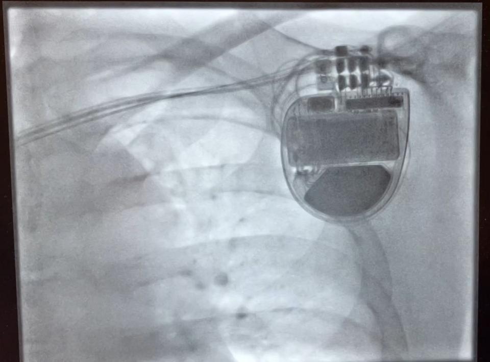 Daily Echo: Eine Röntgenaufnahme von Phil O'Donoghue, die das Implantat zeigt.