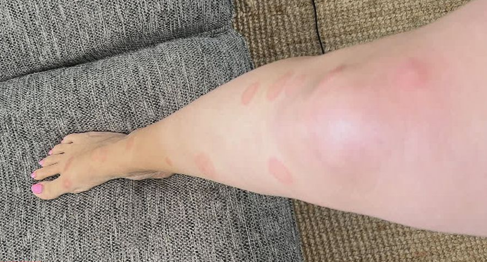 Monica Robertson's leg covered in what she says are bed bug bites, after spending three days on board a P&O Cruise