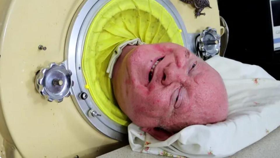 Man living in iron lung after he contracted polio in 1952 dies
