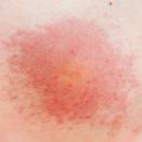 <p><strong>What it looks like:</strong> Bee stings vary from person to person. Some people exhibit only a <a href="https://www.prevention.com/health/a32457704/bee-sting-pictures/" rel="nofollow noopener" target="_blank" data-ylk="slk:small, light spot;elm:context_link;itc:0;sec:content-canvas" class="link ">small, light spot</a>, while others get a larger, red welt. There also might be a white spot at the center where the sting occurred. In the case of a honey bee sting, the barbed stinger is often still attached—which will keep pumping venom into your body until you remove it.</p><p><strong>Symptoms to note:</strong> Bee stings cause moderate pain, which should subside within a few hours. All insect stings can cause life-threatening allergic reactions, and <a href="https://www.prevention.com/health/a32907684/bee-sting-allergic-reaction-symptoms/" rel="nofollow noopener" target="_blank" data-ylk="slk:bee stings;elm:context_link;itc:0;sec:content-canvas" class="link ">bee stings</a> are no exception. Monitor your symptoms after a sting and call 911 if you notice the signs of anaphylaxis, including swelling beyond the sting site, tightness in the chest or throat, or trouble breathing.</p><p><strong>Related: <a href="https://www.prevention.com/health/a32471737/how-to-treat-a-bee-sting/" rel="nofollow noopener" target="_blank" data-ylk="slk:How to Treat a Bee Sting;elm:context_link;itc:0;sec:content-canvas" class="link ">How to Treat a Bee Sting</a></strong></p>