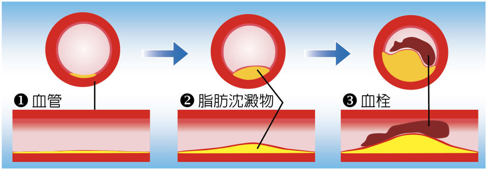 冠狀動脈粥狀血管硬化過程 1.正常動脈 2.形成動脈硬化血塊 3.被血塊阻塞的動脈 圖片出處：謝美玲、陳郁志等(2019冠狀動脈粥狀硬化心臟病之心導管檢查須知)P.4