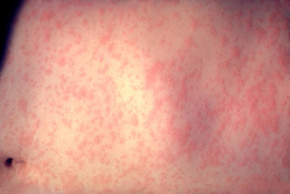 The skin of a patient after three days of measles infection, treated at a New York hospital. (CDC)