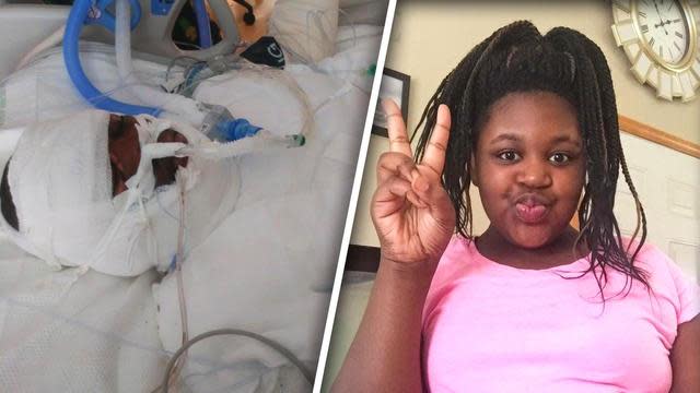 Timiyah Landers is fighting for her life after trying the fire challenge. (Photos: Courtesy of Brandi Owens)