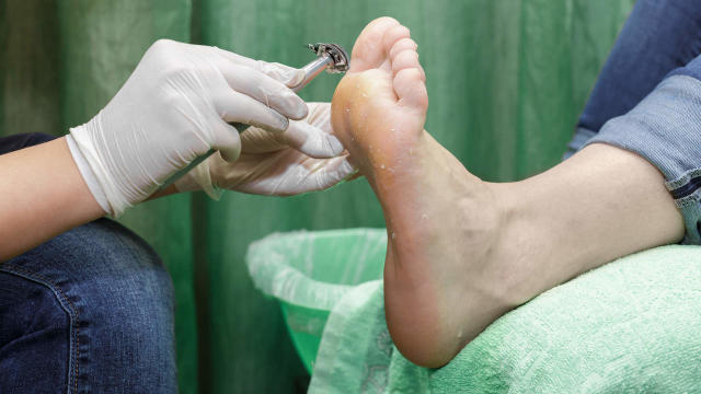 Stomach-churning video shows a man hacking a giant callus off his foot with  a razor blade