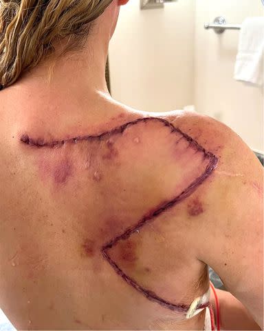 <p>Teddi Mellencamp/Instagram</p> Teddi Mellencamp, who was diagnosed with her 13th Melanoma in September, shares an image of a scar on Instagram Saturday