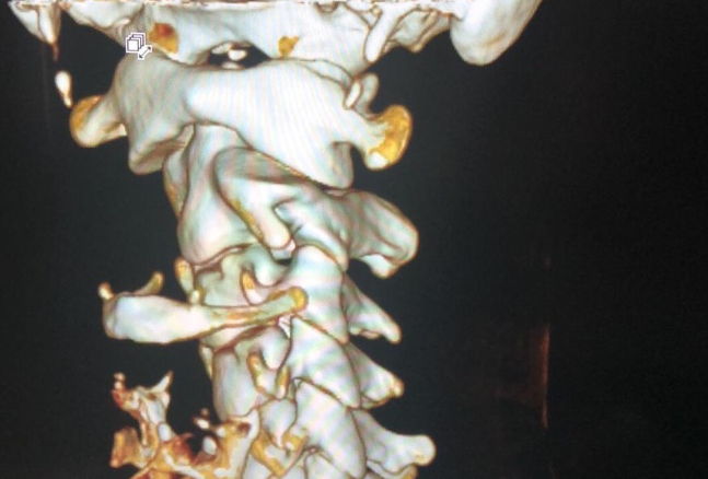 X Ray of Erin Meegan's neck and skull as the Perth woman faces internal decapitation.
