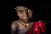 <p>Rohingya Azida Begum, age 11, was shot twice under her arm and her leg by Burmese military, killing her mother as she was fleeing her village in Myanmar on October 10, 2017 in Palongkhali, Bangladesh. Azida now lives with her grandmother, her father having died years ago. Well over a half a million Rohingya refugees have fled into Bangladesh since late August during the outbreak of violence in Rakhine state causing a humanitarian crisis in the region with continued challenges for aid agencies. (Photograph by Paula Bronstein/Getty Images) </p>