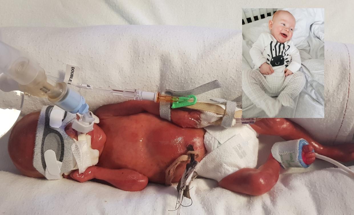 A baby born three days after the abortion limit has recently celebrated his first birthday [Photo: SWNS]