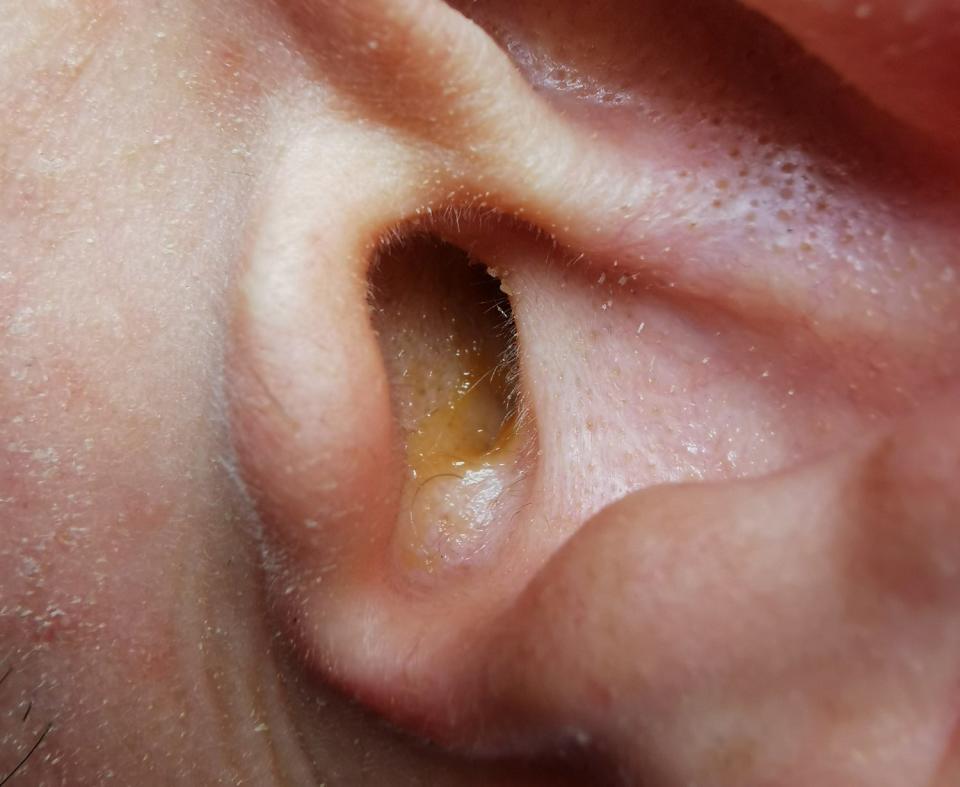 Ear wax in someone's ear