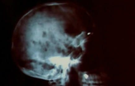 X-ray image of Travis Alexander's skull that was shown in court.