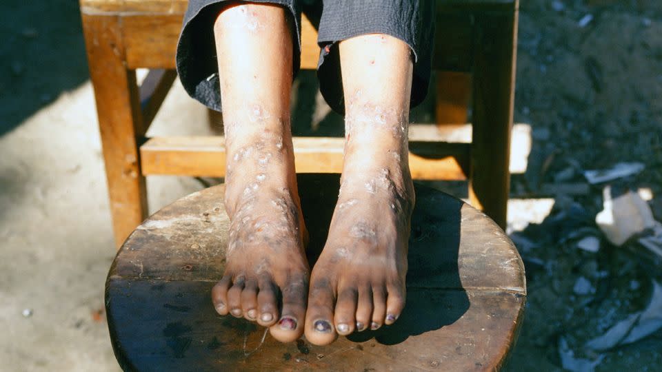 A patient in Bangladesh with "blackfoot disease," associated with long-term exposure to arsenic. - Seth H. Frisbie