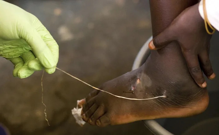 A hand in a surgical glove removing a Guinea worm from a child's foot