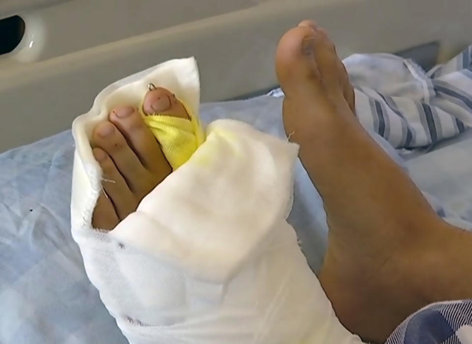 The young man's foot after the surgery. (AsiaWire)