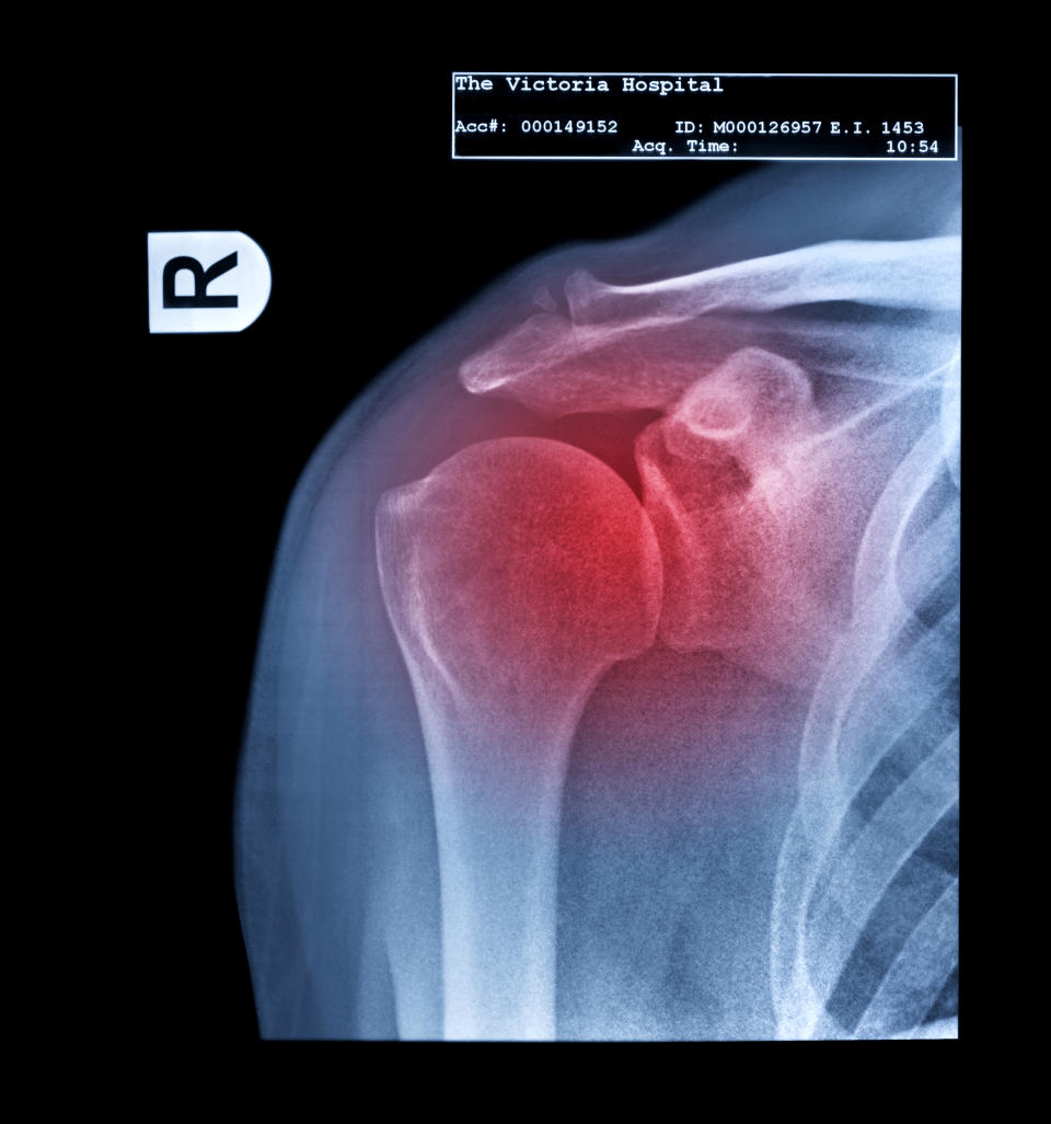 x-ray image of an inflamed shoulder joint