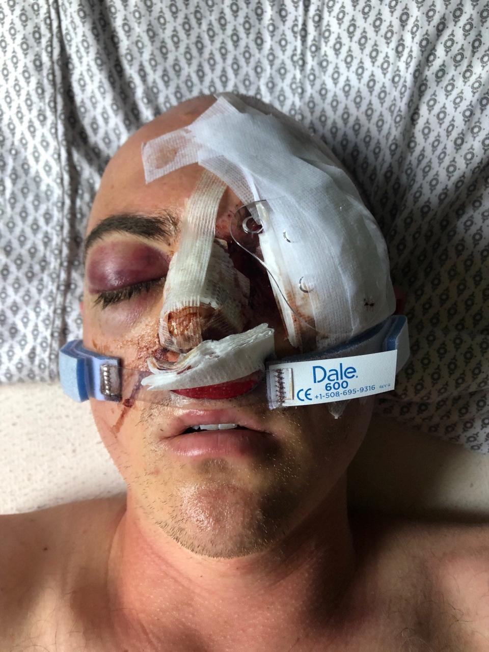 Soren Stevenson lost an eye after being shot with a rubber bullet during protests after the death of George Floyd in summer 2020. He claims in a lawsuit a Minneapolis police officer shot him.