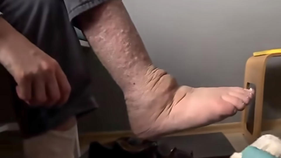 Tomasz’s deformed and wounded feet. Source: CEN/Australscope