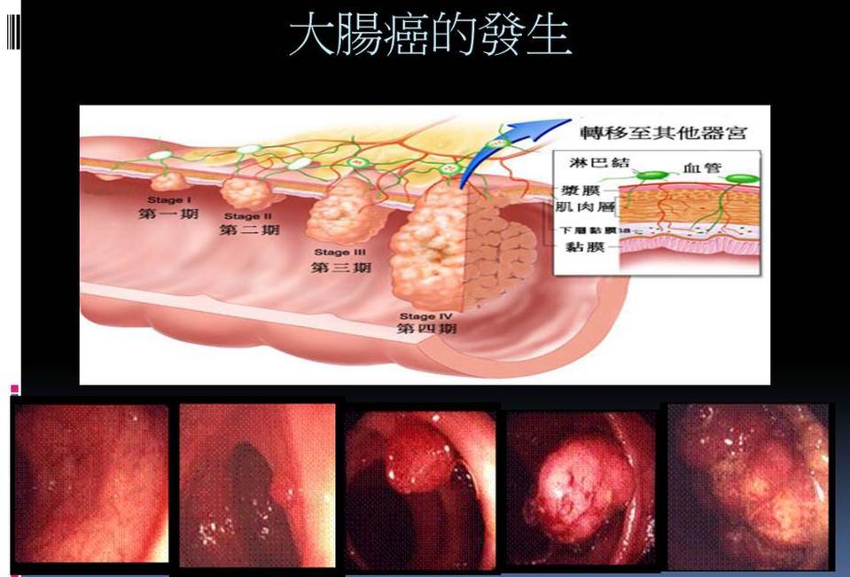 大腸癌的生長過程。（圖／安南醫院提供）