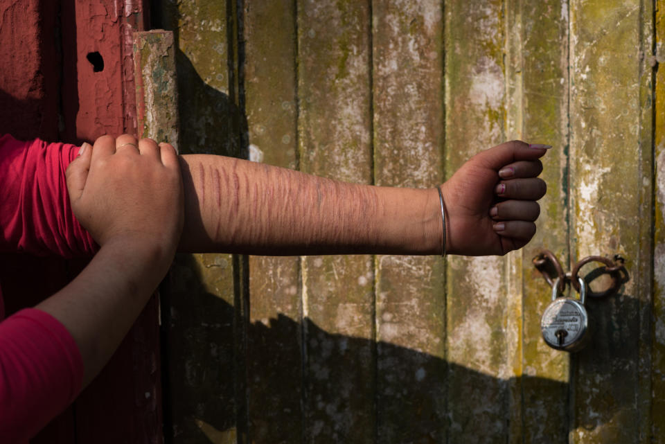 M., 16, her sleeve rolled up, displays her arm, which is etched with parallel lines where she has cut herself.