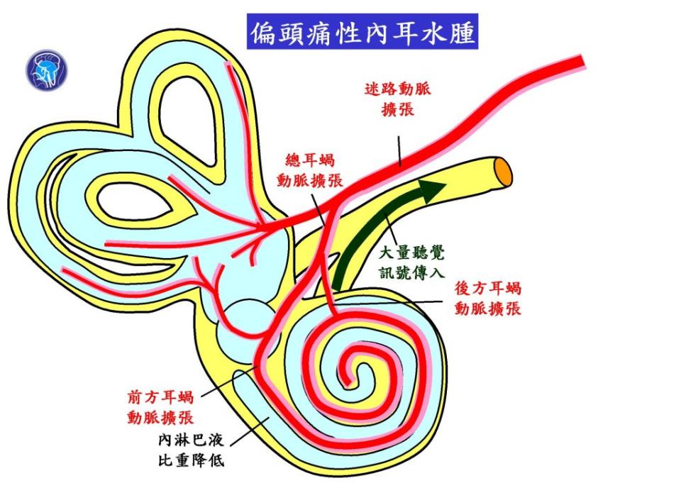 偏頭痛發作時，內耳血流大增，大量水分進入膜性迷路，內耳水腫，內淋巴液比重變輕，出現耳蝸病變，發出聽覺訊息，遂成發炎性耳鳴。（醫師陳建志提供）