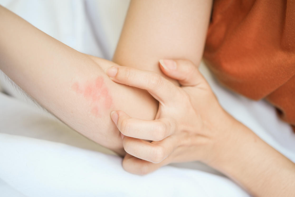 ¿Sufres de psoriasis y no has encontrada una solución? Foto: Getty Images