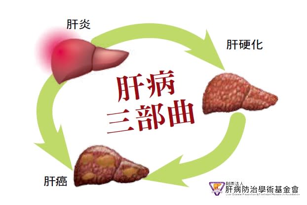 Liver Fibrosis