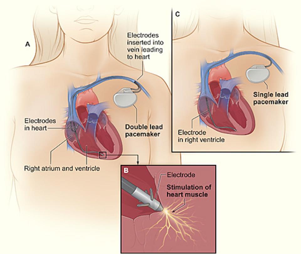 Pacemaker electrodes are implanted directly in the heart. <a href="https://www.nhlbi.nih.gov/sites/default/files/inline-images/images_279.jpg" rel="nofollow noopener" target="_blank" data-ylk="slk:National Heart, Lung, and Blood Institute;elm:context_link;itc:0;sec:content-canvas" class="link ">National Heart, Lung, and Blood Institute</a>