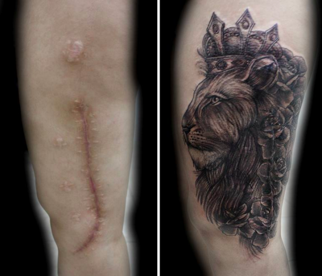 Help Cancer Survivors Turn Their Scars into Art