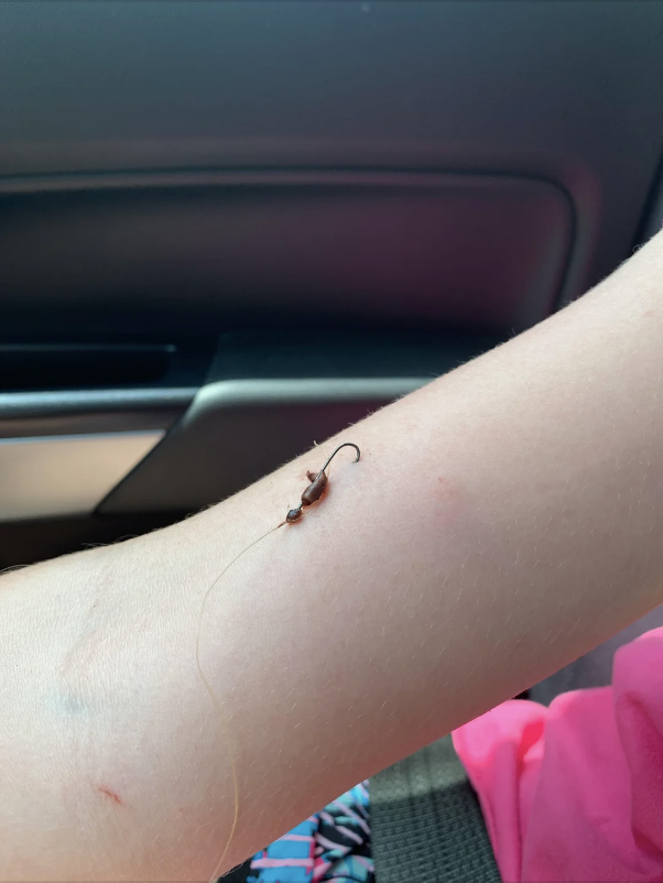 A fish hook in someone's skin