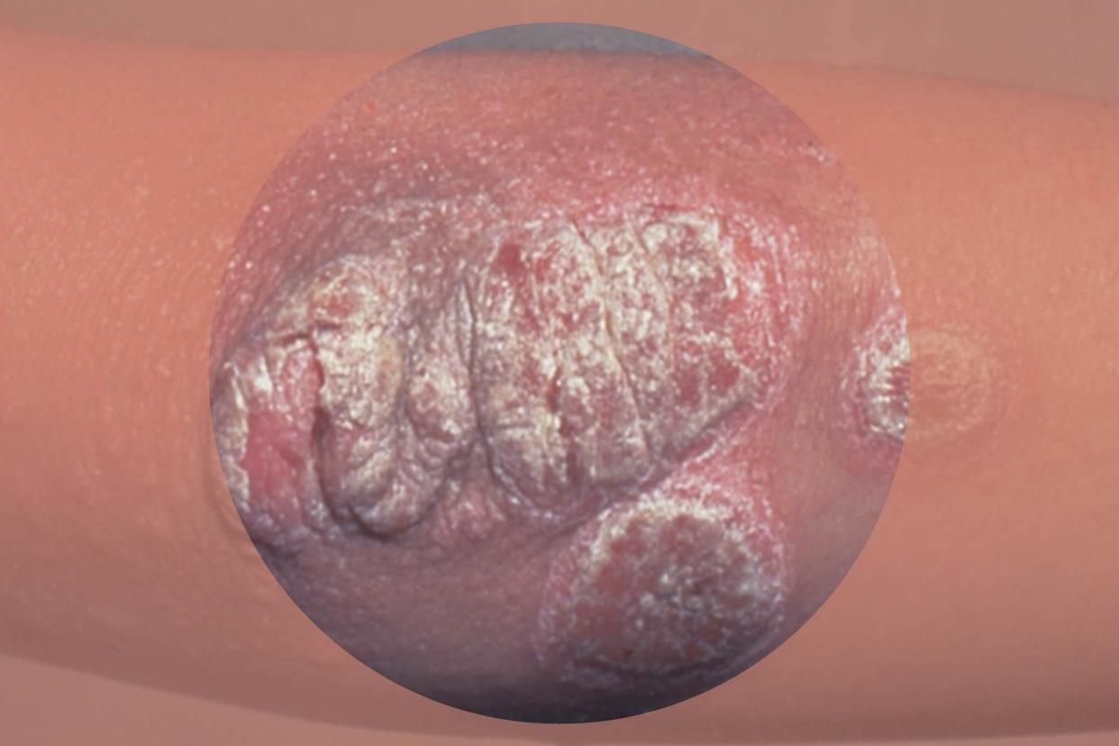 plaque psoriasis