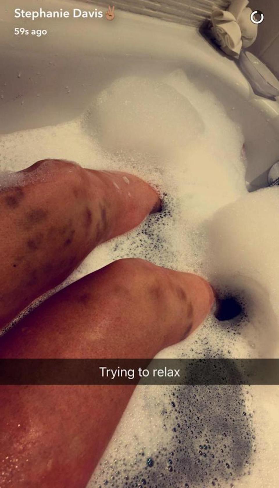 The mother-of-one showed off some mysterious marks on both of her legs (Copyright: Snapchat/Stephanie Davis) 