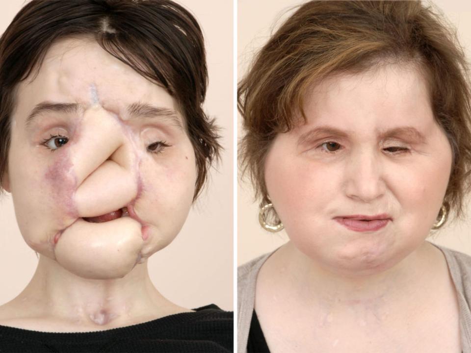 Ms Stubblefield underwent several surgeries before her transplant Pic: Cleveland Clinic